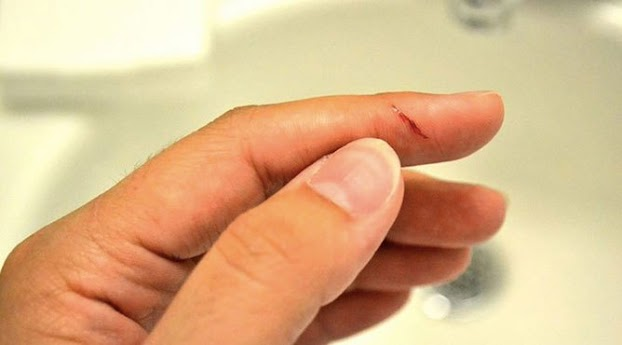 Mộng thấy người lạ bị đứt ngón tay